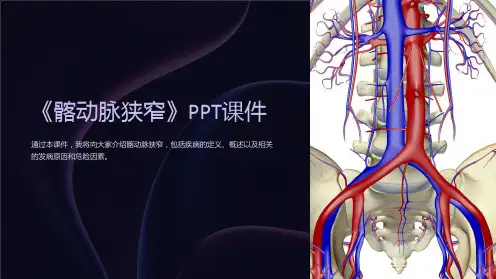 《髂动脉狭窄》课件