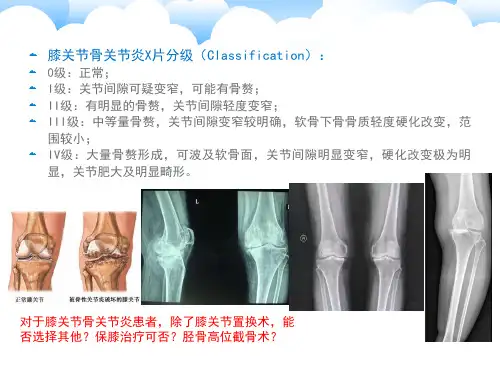 保膝治疗之1胫骨高位截骨术