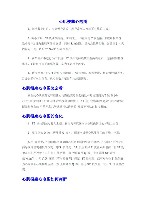 心肌梗塞心电图