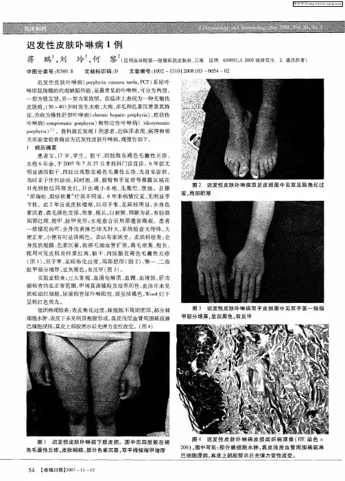 迟发性皮肤卟啉病1例