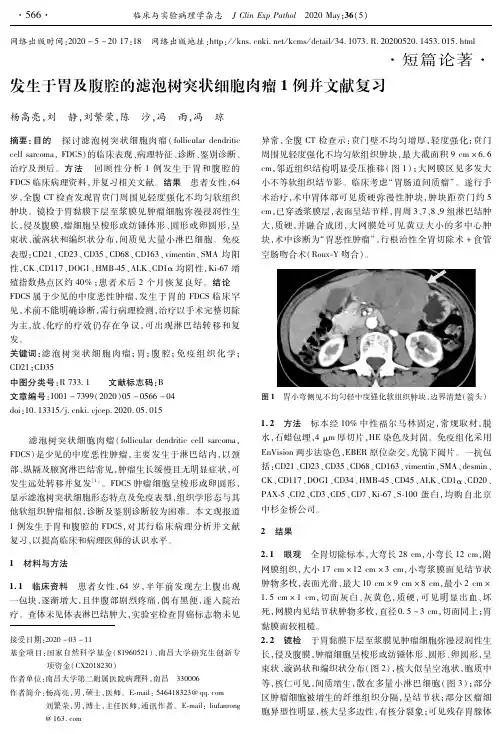 发生于胃及腹腔的滤泡树突状细胞肉瘤1例并文献复习