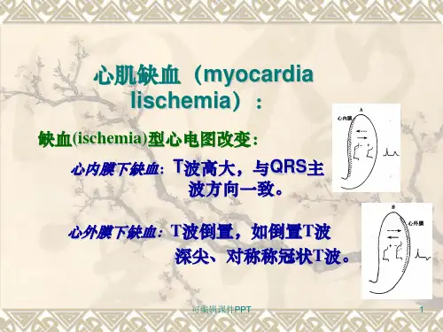 心肌缺血心电图ppt课件