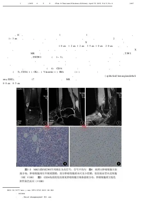 软组织多发上皮样血管内皮瘤一例