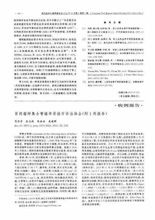 肾肉瘤样集合管癌伴肾结石诊治体会(附1例报告)