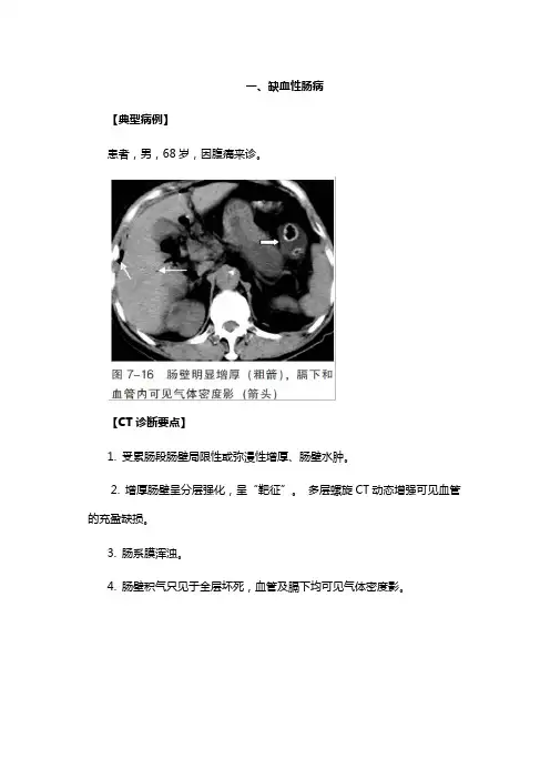 缺血性肠病和肠结核CT影像诊断要点