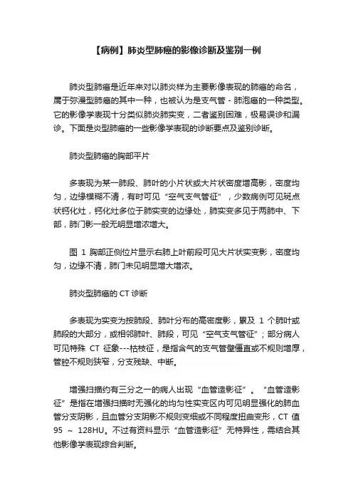 【病例】肺炎型肺癌的影像诊断及鉴别一例