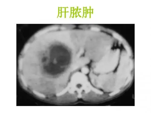 肝脏疾病影像诊断(1)ppt课件