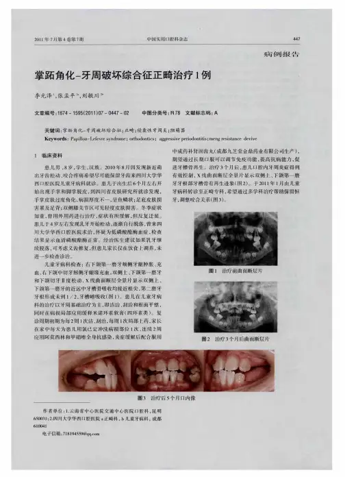 掌跖角化-牙周破坏综合征正畸治疗1例
