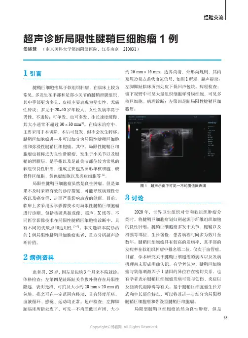 超声诊断局限性腱鞘巨细胞瘤1 例