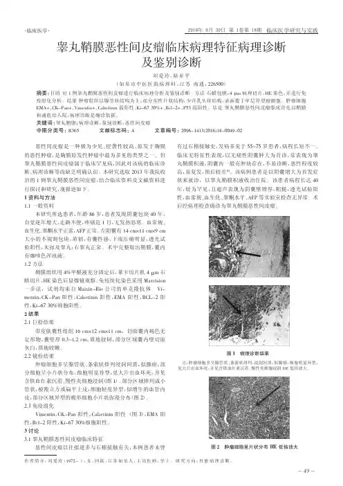 睾丸鞘膜恶性间皮瘤临床病理特征病理诊断及鉴别诊断