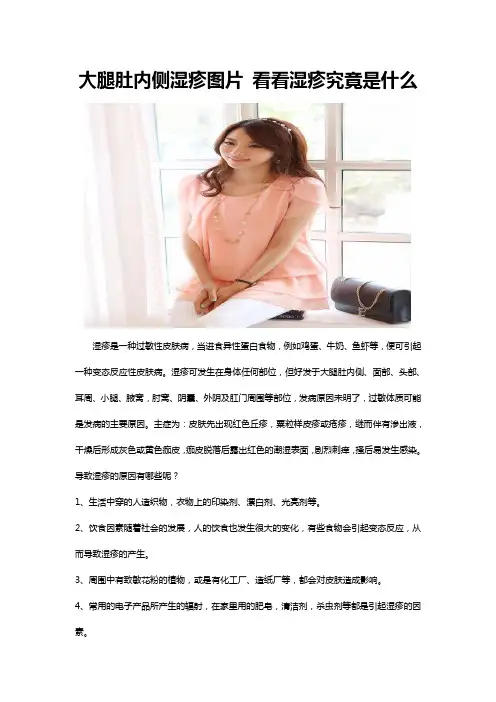 大腿肚内侧湿疹图片 看看湿疹究竟是什么