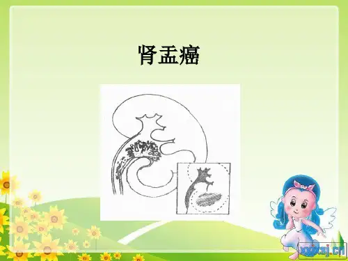 《肾盂癌》ppt课件
