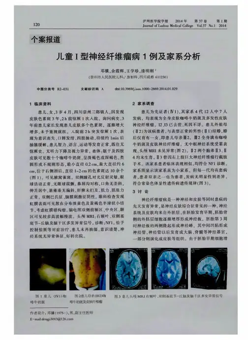 儿童I型神经纤维瘤病1例及家系分析