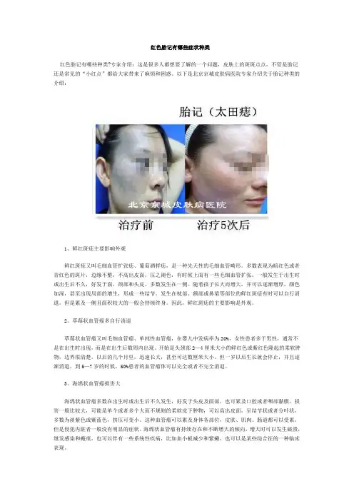 红色胎记有哪些症状种类
