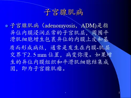 子宫腺肌病PPT课件