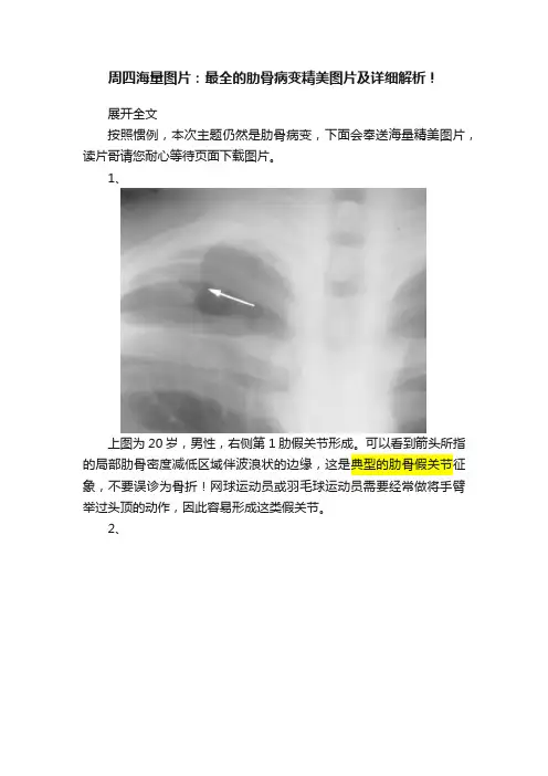 周四海量图片：最全的肋骨病变精美图片及详细解析！