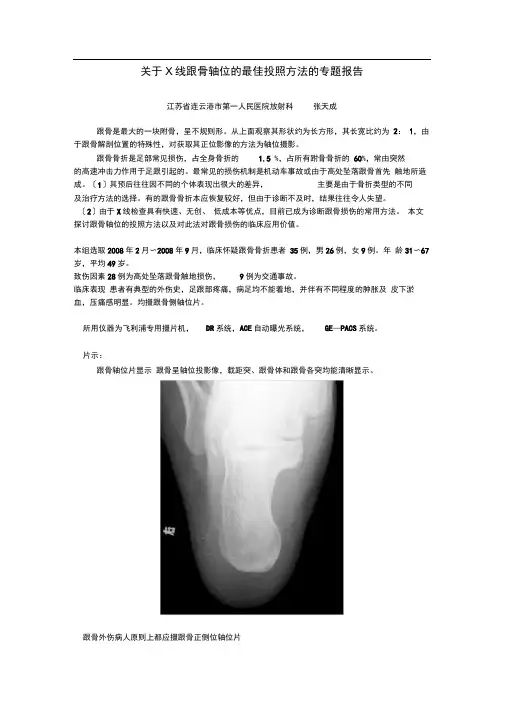 X线跟骨轴位的最佳投照方法以及对跟骨骨折临床诊断的价值
