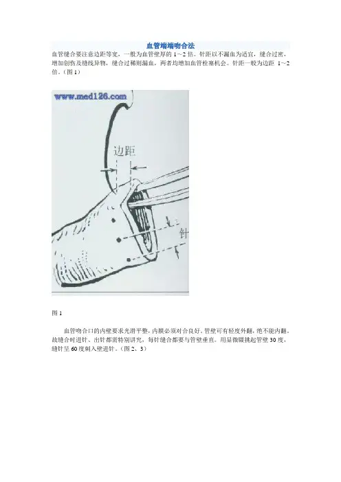 血管端端吻合法