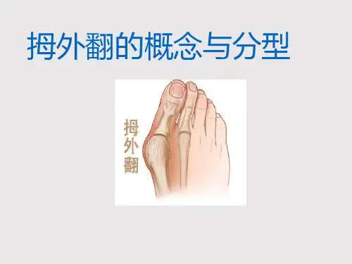 拇外翻的概念与分型
