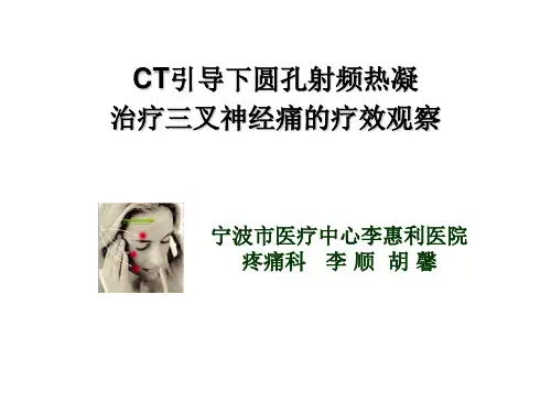 圆孔穿刺射频热凝治疗三叉神经痛PPT演示幻灯片