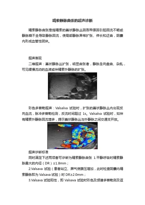 精索静脉曲张的超声诊断