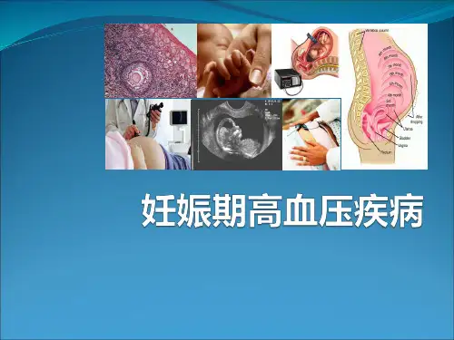 妇产科学--妊娠期高血压疾病