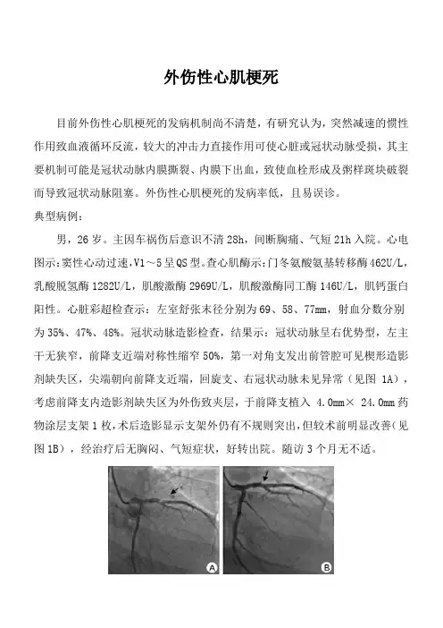外伤性心肌梗死