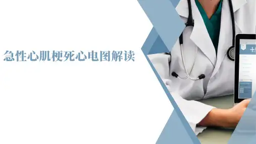 急性心肌梗死心电图解读