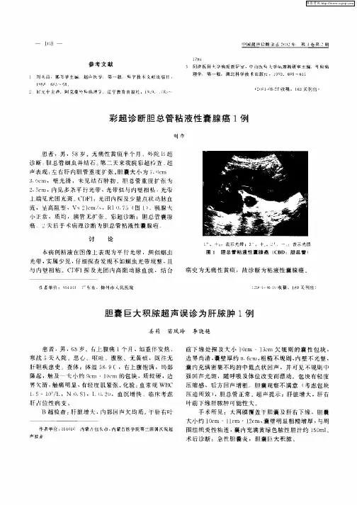 胆囊巨大积脓超声误诊为肝脓肿1例