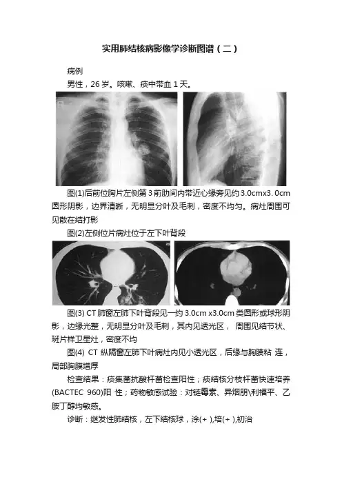实用肺结核病影像学诊断图谱（二）