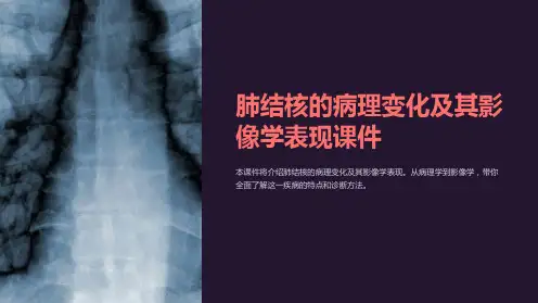 肺结核的病理变化及其影像学表现课件