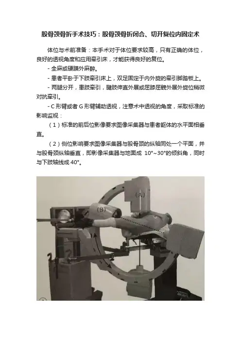 股骨颈骨折手术技巧：股骨颈骨折闭合、切开复位内固定术