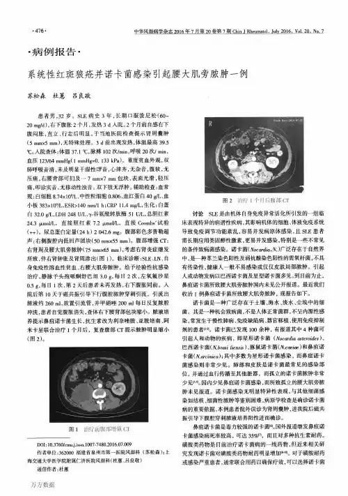 系统性红斑狼疮并诺卡菌感染引起腰大肌旁脓肿一例论文