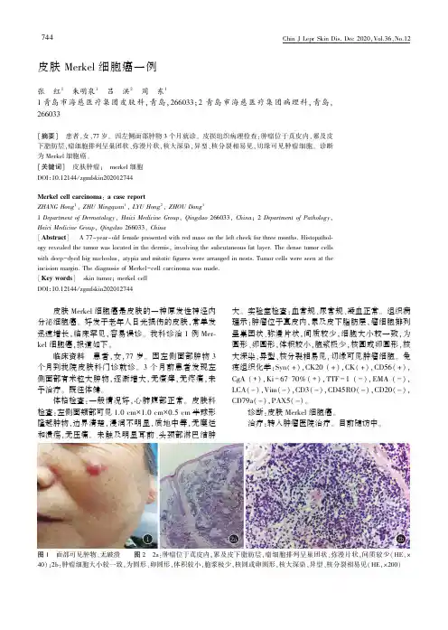 皮肤Merkel细胞癌一例