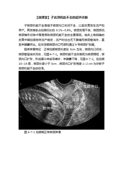 【微课堂】子宫颈机能不全的超声诊断