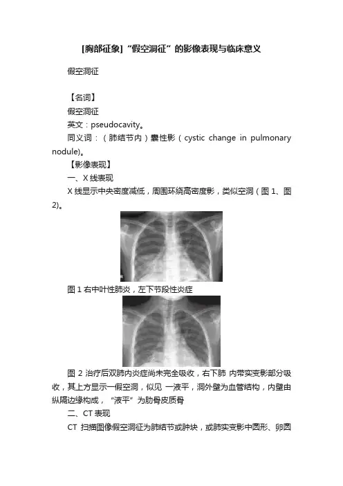 [胸部征象]“假空洞征”的影像表现与临床意义
