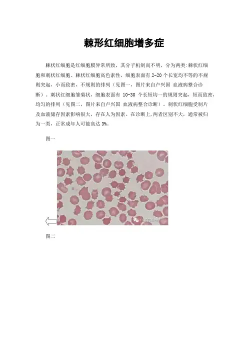 棘形红细胞增多症