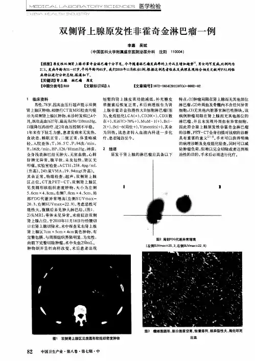 双侧肾上腺原发性非霍奇金淋巴瘤一例