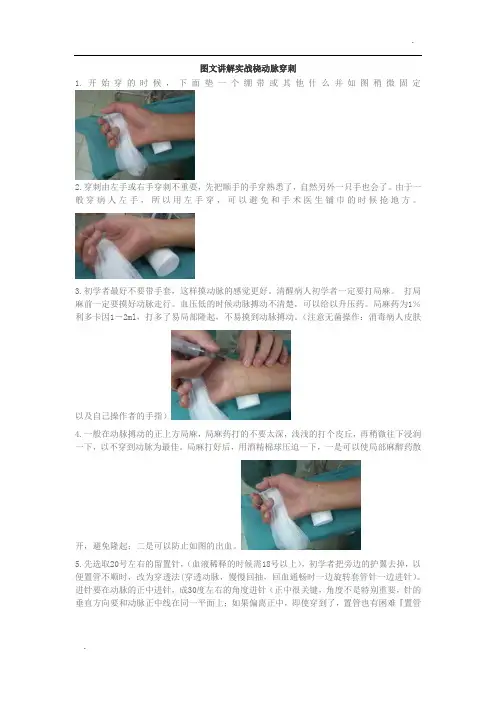 -图文讲解实战桡动脉穿刺