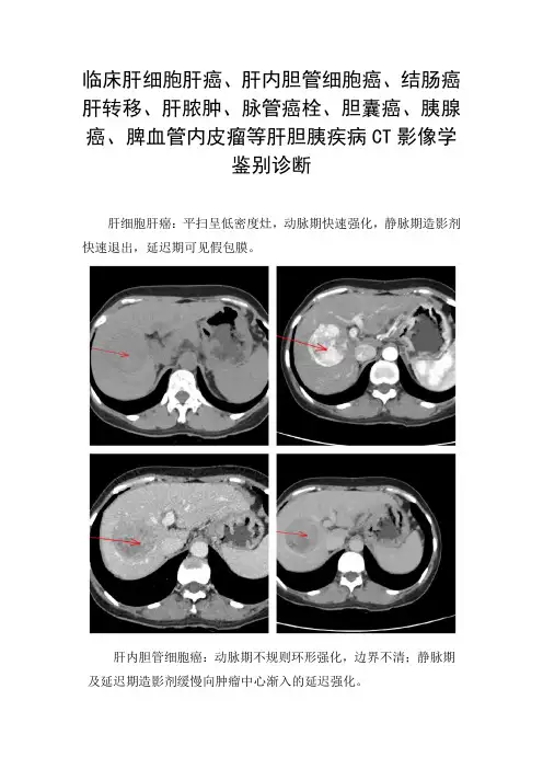 肝细胞肝癌、结肠癌肝转移、肝脓肿、脉管癌栓、胆囊癌、脾血管内皮瘤等肝胆胰疾病CT影像学鉴别诊断
