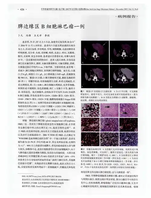 脾边缘区B细胞淋巴瘤一例