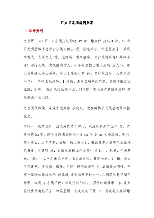 巨大寻常疣病例分享