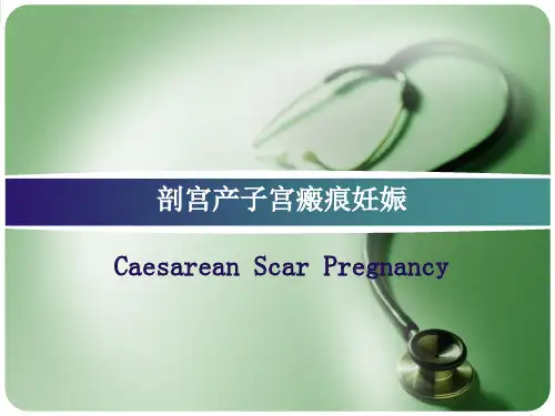 剖宫产子宫瘢痕妊娠PPT课件