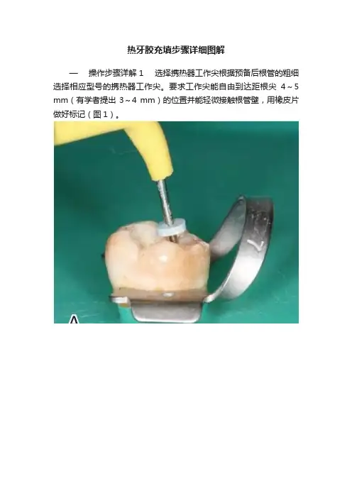 热牙胶充填步骤详细图解