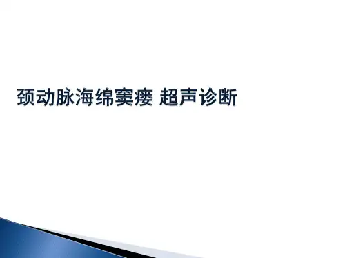 颈动脉海绵窦瘘超声诊断