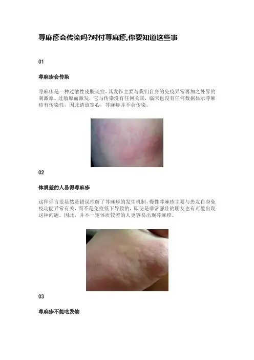 荨麻疹会传染吗对付荨麻疹,你要知道这些事