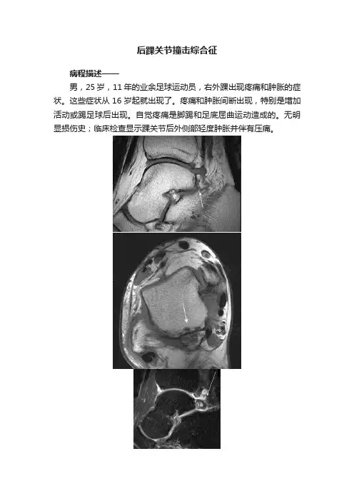 后踝关节撞击综合征