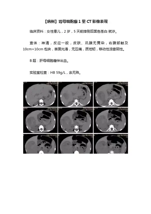 【病例】肾母细胞瘤1里CT影像表现