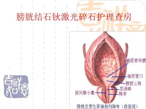 膀胱结石钬激光碎石手术护理查房ppt课件