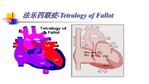 法乐四联症